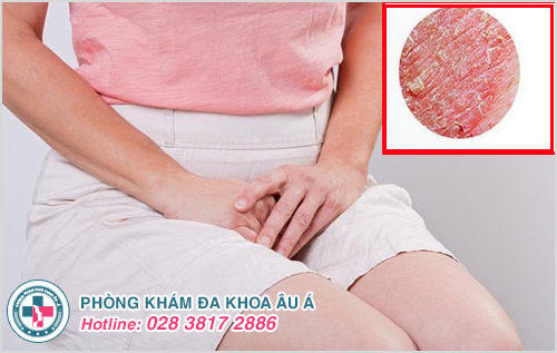 ngứa và tróc da vùng kín có sao không