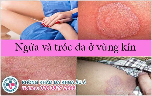 ngứa và tróc da vùng kín có sao không