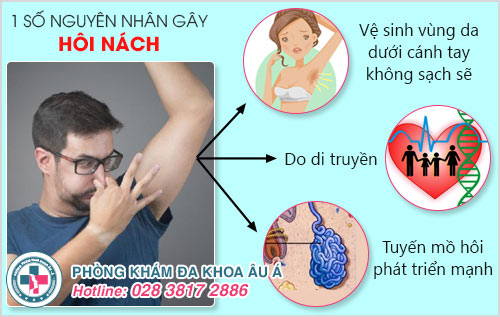 trị hôi nách bằng laser giá bao nhiêu