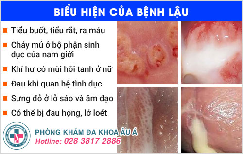 xét nghiệm bệnh lậu bao nhiêu tiền