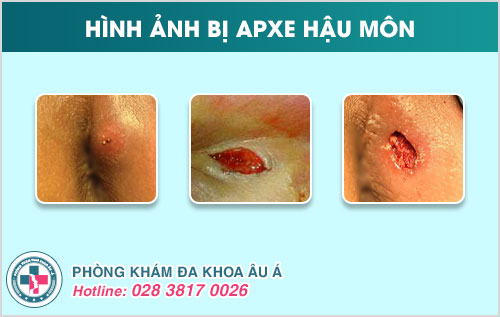 Apxe hậu môn có thể tự khỏi không