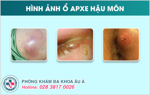 apxe hậu môn nguy hiểm như thế nào