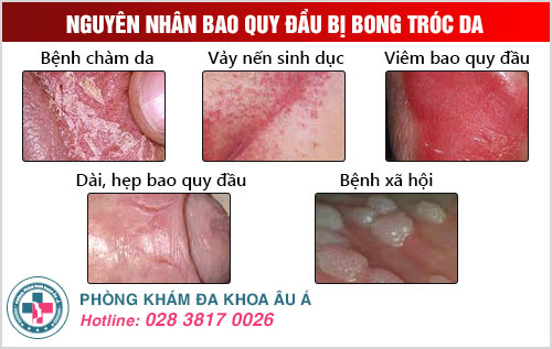 Bao quy đầu bị bong tróc da