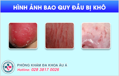 Bao quy đầu bị khô