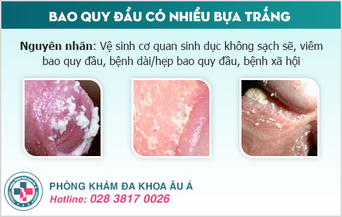 Bao quy đầu có nhiều bựa trắng