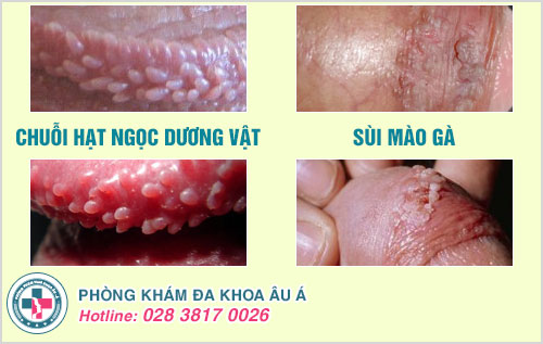 Bị chuỗi hạt ngọc có quan hệ được không