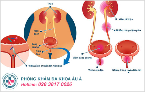 Bị viêm đường tiết niệu có quan hệ được không