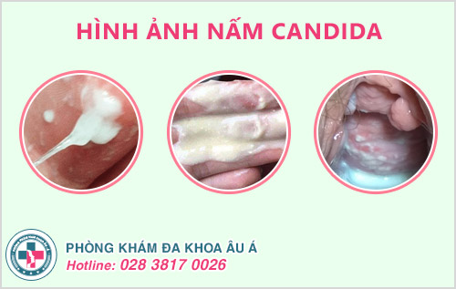 biểu hiện nhiễm nấm Candida ở nữ