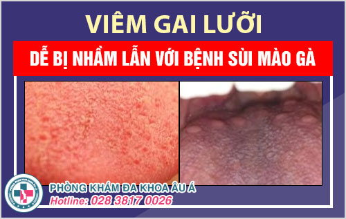 cách chữa viêm gai lưỡi tại nhà