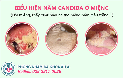 cách nhận biết nấm Candida qua nước bọt