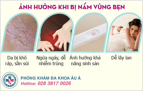 cách trị nấm bẹn tại nhà