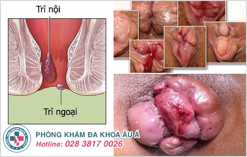 Cắt trĩ xong có đi vệ sinh được không