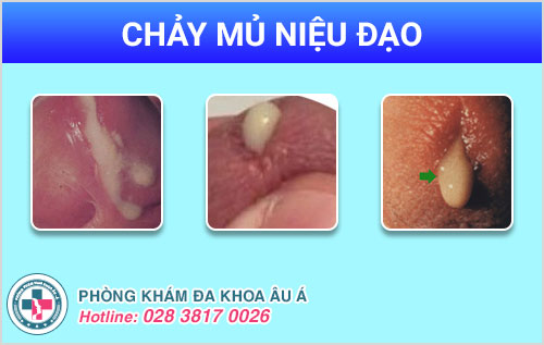 Chảy mủ niệu đạo