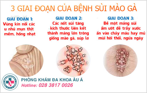 chữa sùi mào gà ở quận 1