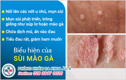 Chữa sùi mào gà tại Tân Bình