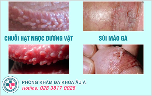 Chuỗi hạt ngọc dương vật có hại không