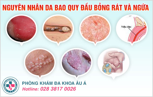 Da bao quy đầu bỏng rát và ngứa