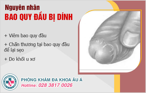 Dấu hiệu bao quy đầu bị dính