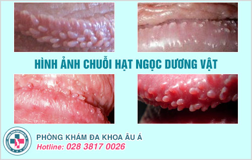 Dấu hiệu chuỗi hạt ngọc dương vật