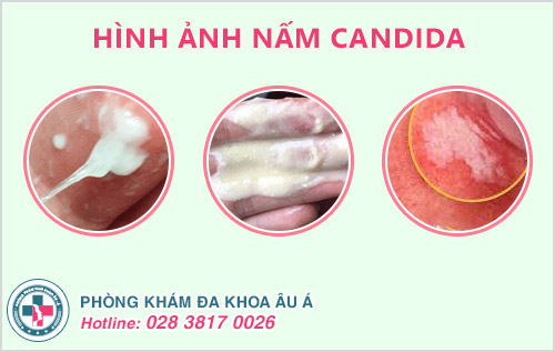 Dấu hiệu nhiễm nấm Candida ở nam giới