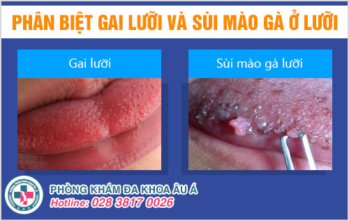 gai lưỡi và sùi mào gà