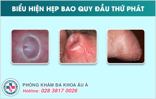 Hẹp bao quy đầu thứ phát