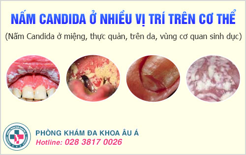 Hướng dẫn chẩn đoán và điều trị nấm Candida