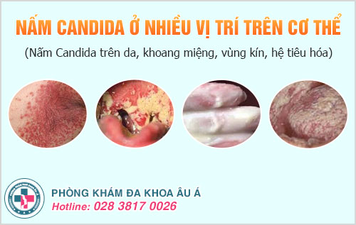 Nấm Candida chết ở nhiệt độ bao nhiêu
