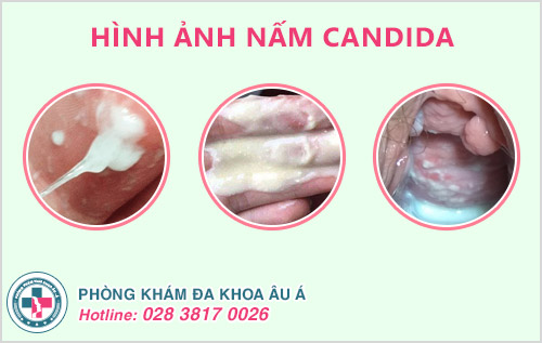 Nấm Candida có lây không
