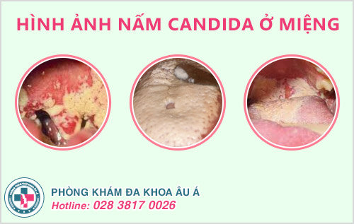 Nấm Candida có lây qua đường miệng không