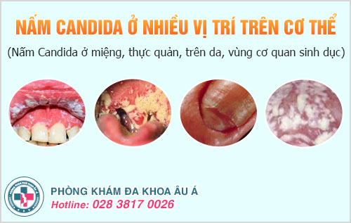 Nấm Candida ủ bệnh bao lâu