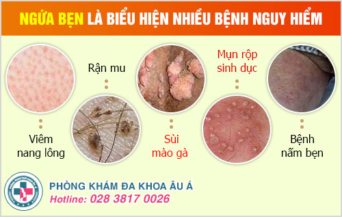 ngứa bẹn