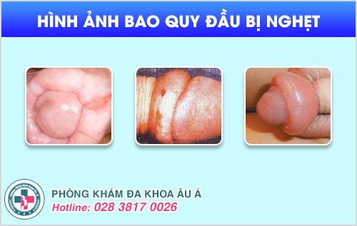 Nguyên nhân gây nghẹt bao quy đầu