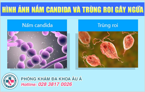 Đừng chủ quan khi nhiễm nấm Candida và trùng roi gây ngứa