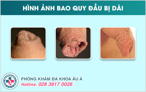 Phương pháp điều trị dài bao quy đầu