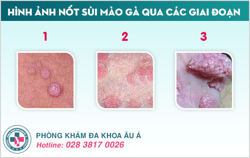 Sùi mào gà ủ bệnh bao lâu thì phát bệnh