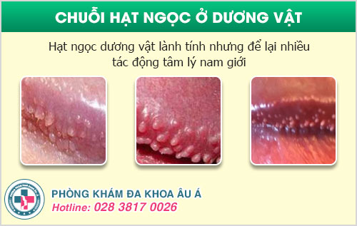 Tại sao bị chuỗi hạt ngọc dương vật