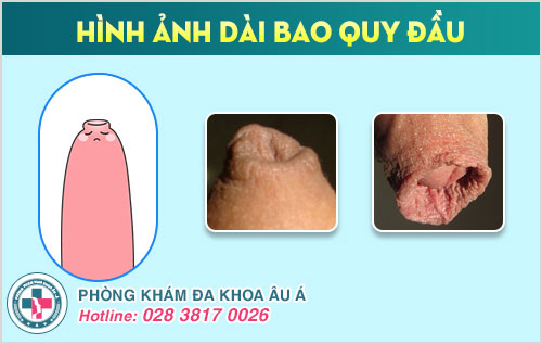 tại sao dài bao quy đầu gây xuất tinh sớm