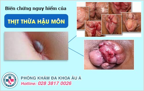 Thịt thừa hậu môn có hết không