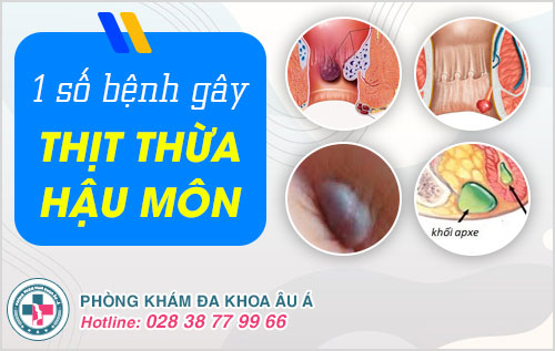 Thịt thừa hậu môn có sao không