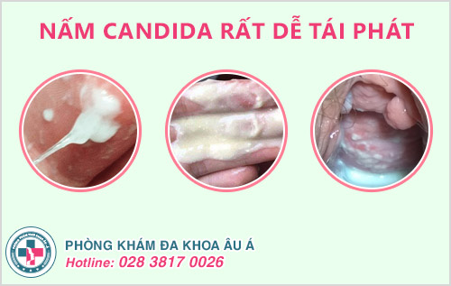 Thời gian ủ bệnh nấm Candida