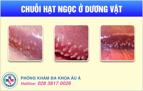 Thuốc trị chuỗi hạt ngọc dương vật