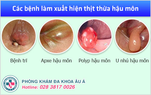 Thuốc trị thịt thừa hậu môn