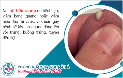 Tiểu ra mủ là bệnh gì