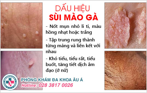 Tôi đã chữa khỏi sùi mào gà