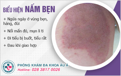 trị nấm bẹn tận gốc