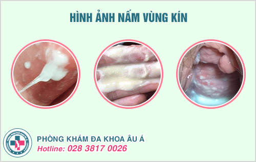 trị tận gốc bệnh nấm vùng kín