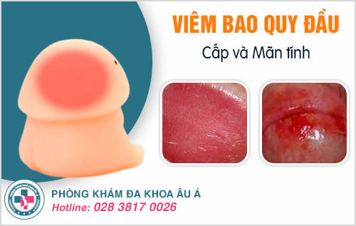 Viêm bao quy đầu cấp và mãn tính