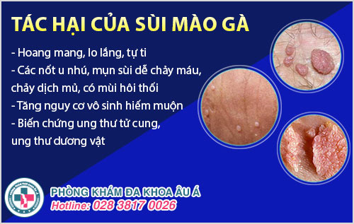 Vợ bị sùi mào gà chồng có bị không