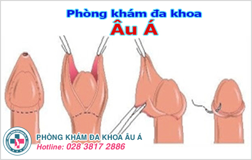 Thủ thuật cắt bao quy đầu an toàn, hiệu quả tại Phòng Khoa Đa Khoa Âu Á